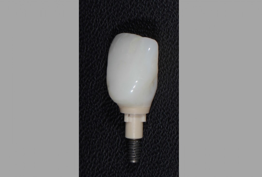 Socket preservation with cerabone® - Dr. Rahib Adi Nader