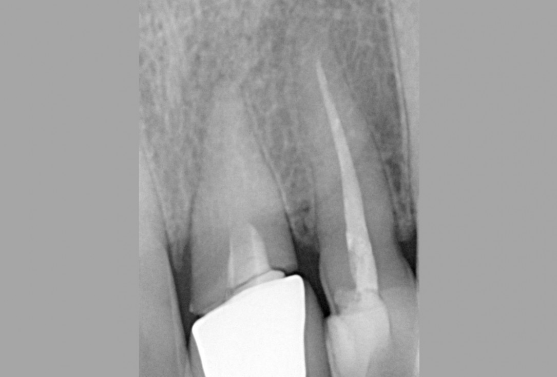Socket preservation with cerabone® - Dr. Rahib Adi Nader