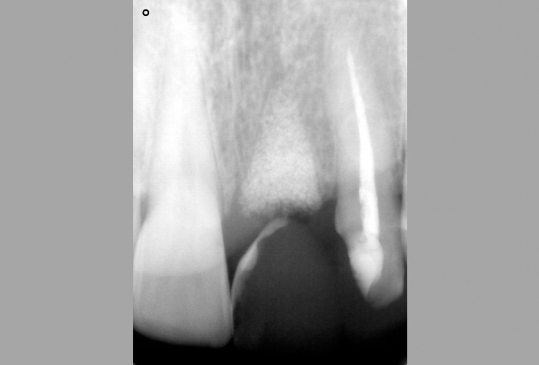 Socket preservation with cerabone® - Dr. Rahib Adi Nader