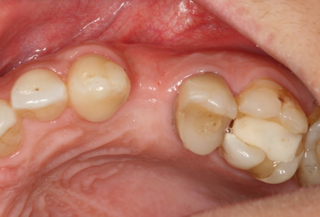 botiss cerabone® & Jason® membrane for horizontal augmentation - clinical case by Prof. Dr. Dr. D. Rothamel