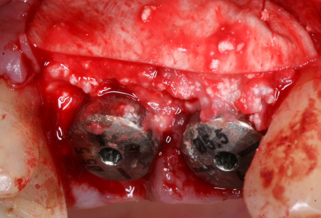 Immediate implantation with maxresorb® inject - Dr. D. Jelušić