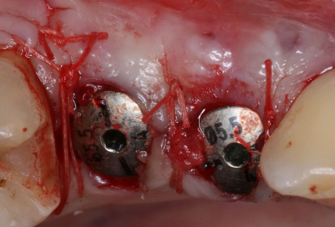 Immediate implantation with maxresorb® inject - Dr. D. Jelušić