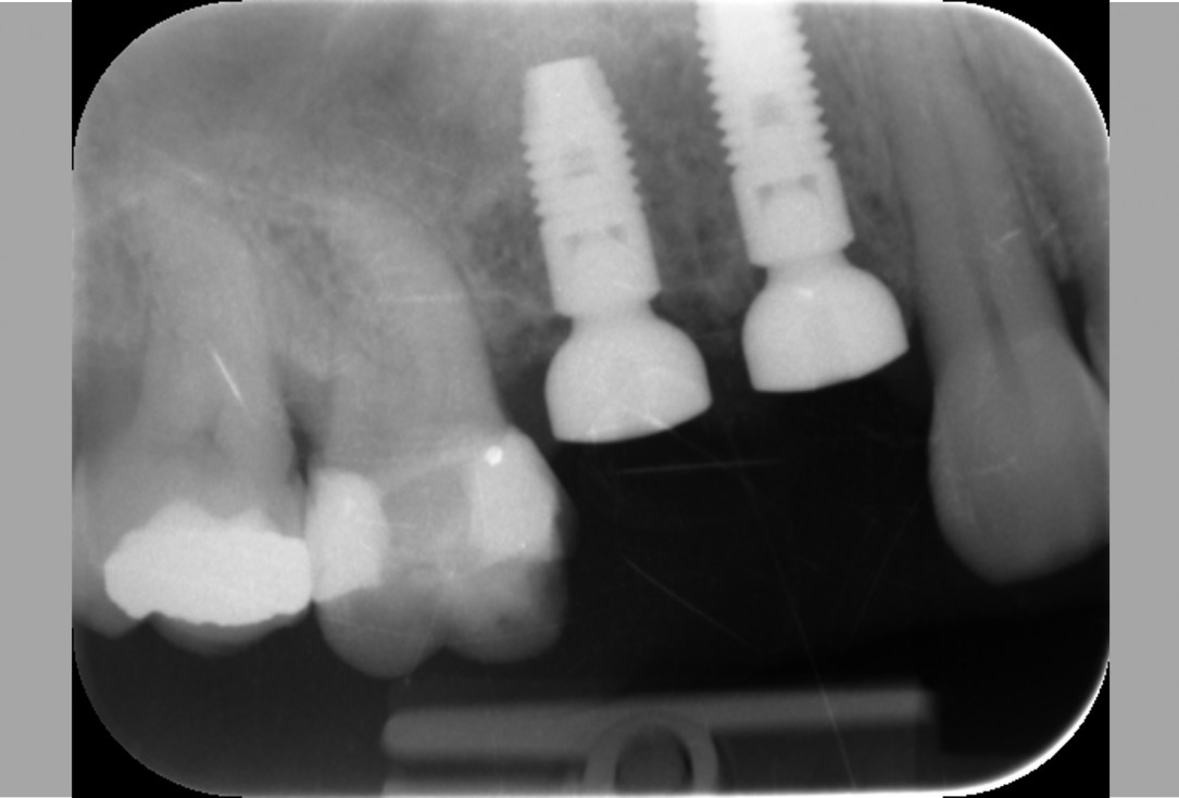 Immediate implantation with maxresorb® inject - Dr. D. Jelušić