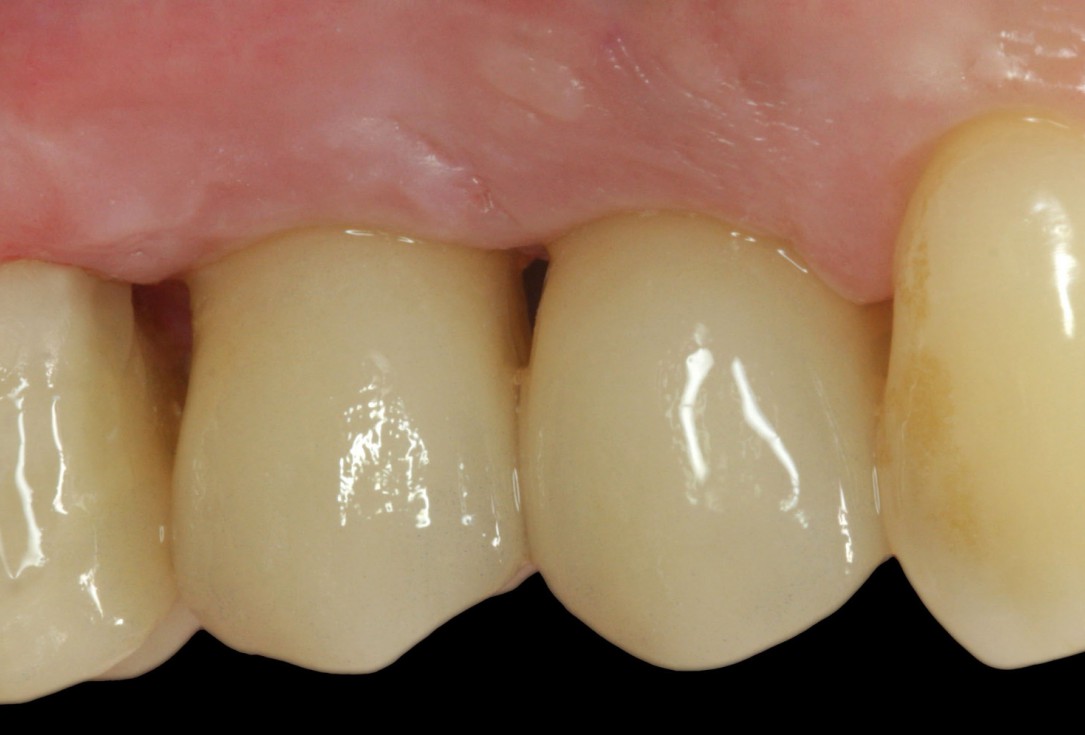 Immediate implantation with maxresorb® inject - Dr. D. Jelušić