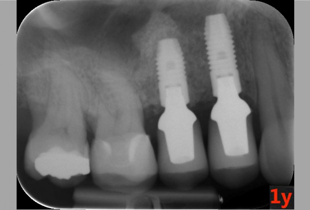 Immediate implantation with maxresorb® inject - Dr. D. Jelušić