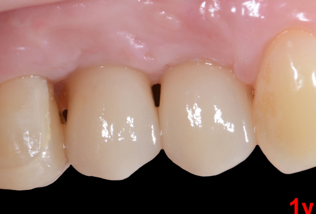 Immediate implantation with maxresorb® inject - Dr. D. Jelušić