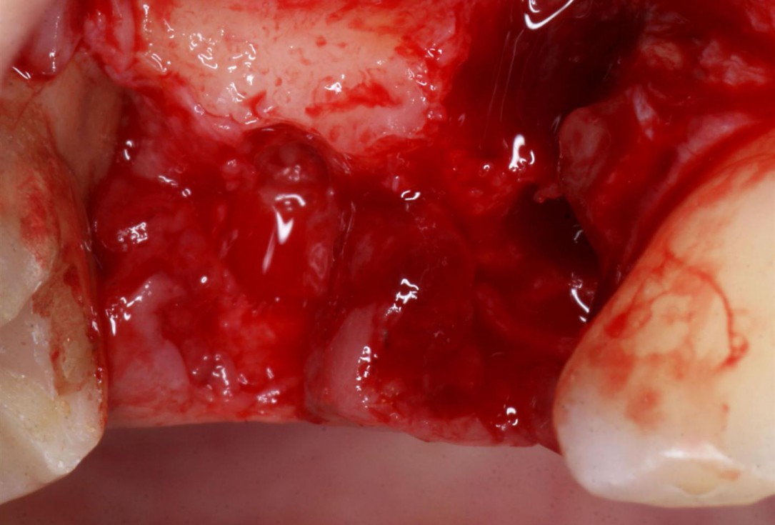 Immediate implantation with maxresorb® inject - Dr. D. Jelušić