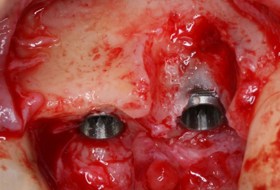 Immediate implantation with maxresorb® inject - Dr. D. Jelušić