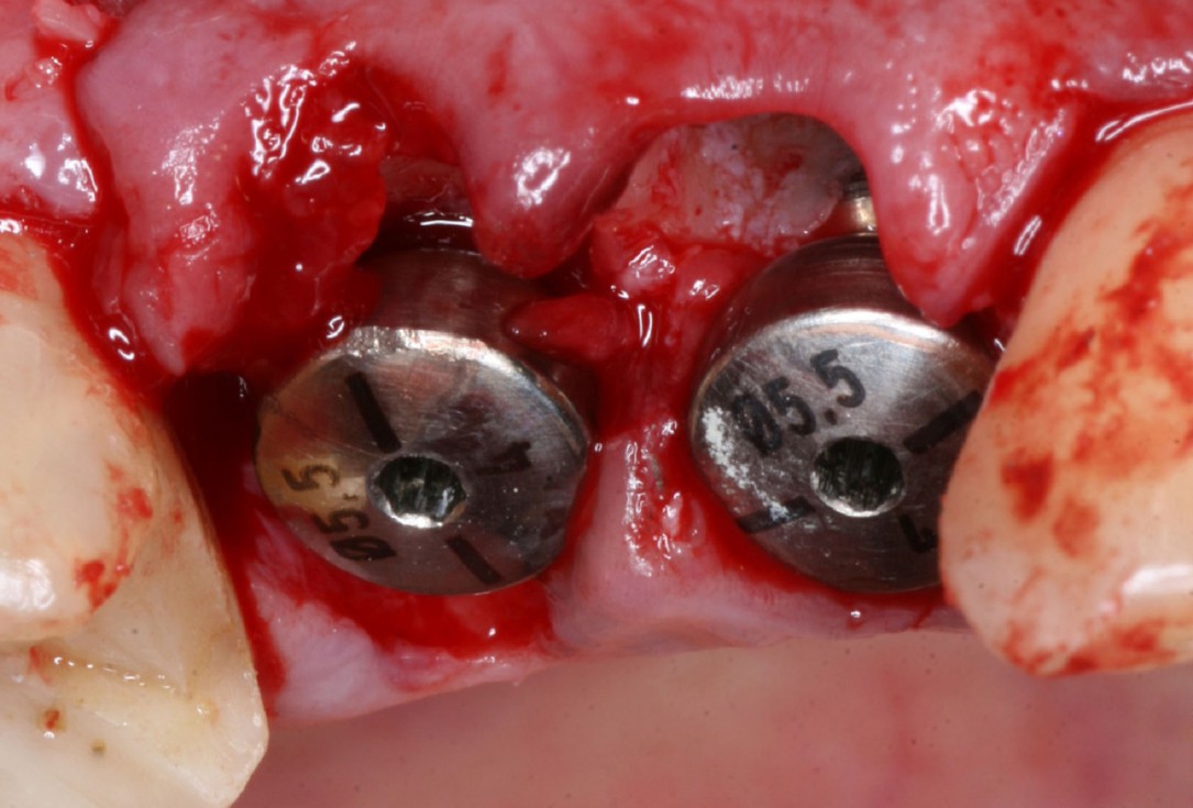 Immediate implantation with maxresorb® inject - Dr. D. Jelušić