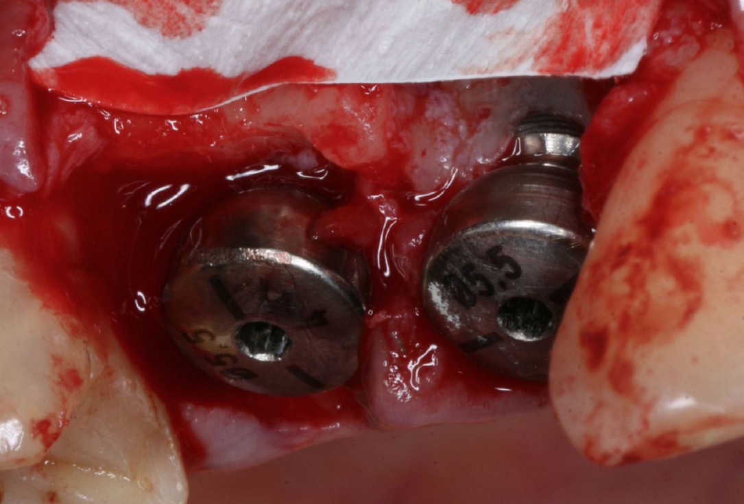 Immediate implantation with maxresorb® inject - Dr. D. Jelušić