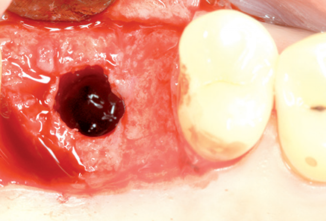 Internal Sinus lift - Dr. Frank Kistler