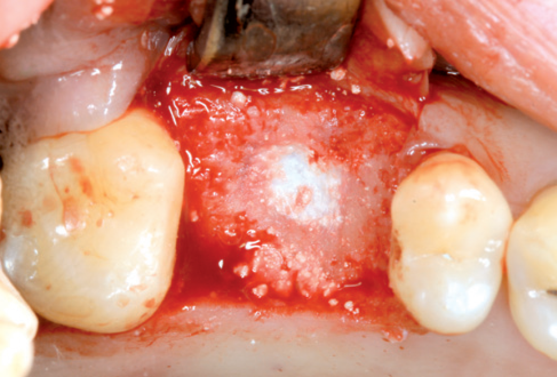 Internal Sinus lift - Dr. Frank Kistler