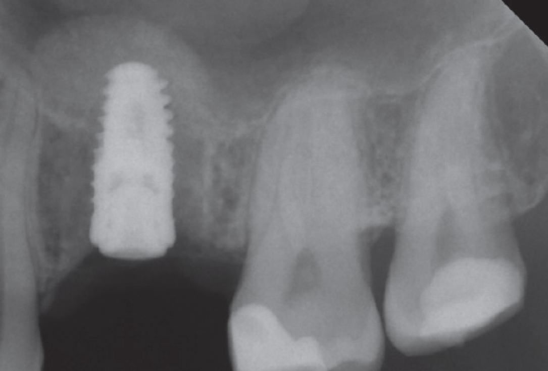 10/10 Internal sinus lift with maxresorb® inject - case Dr. Frank Kistler