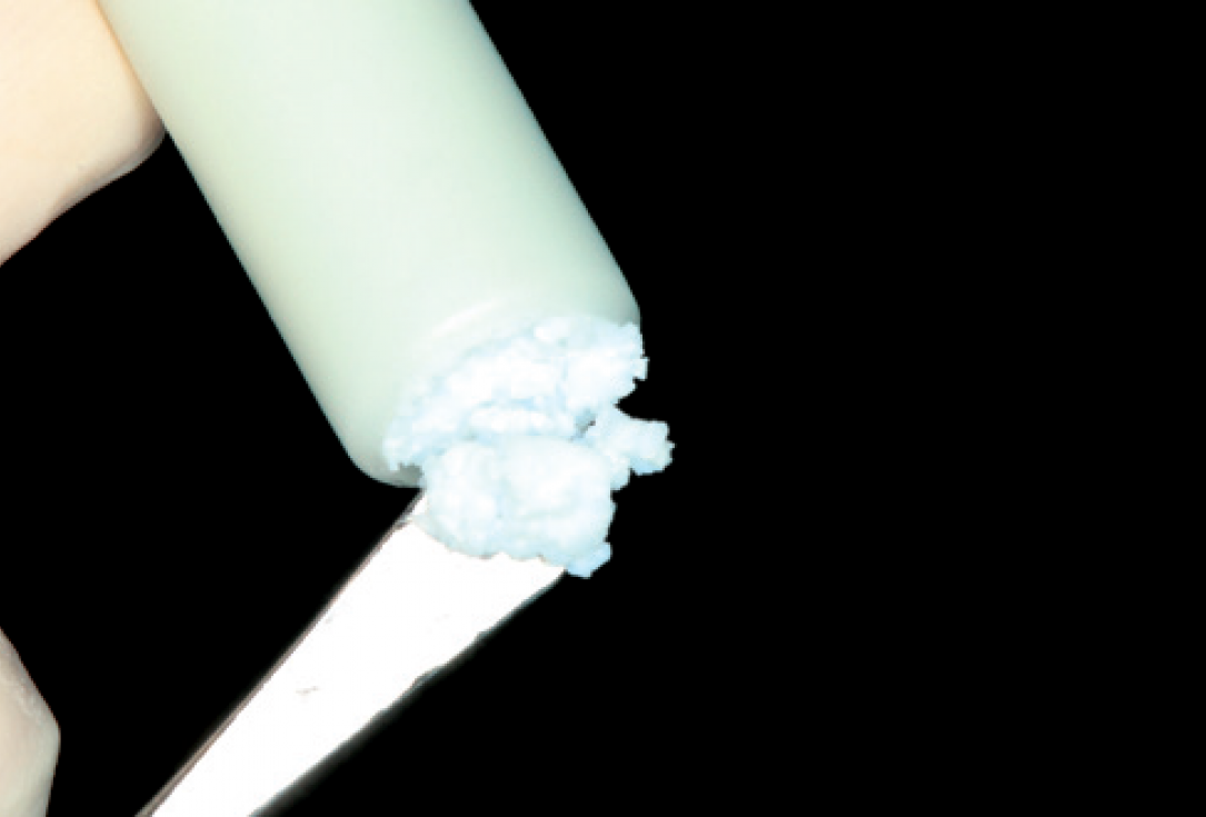 05/10 Internal sinus lift with maxresorb® inject - case Dr. Frank Kistler