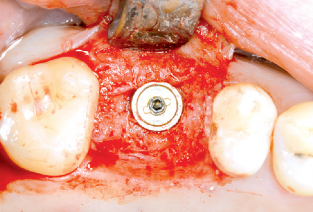 Internal Sinus lift - Dr. Frank Kistler