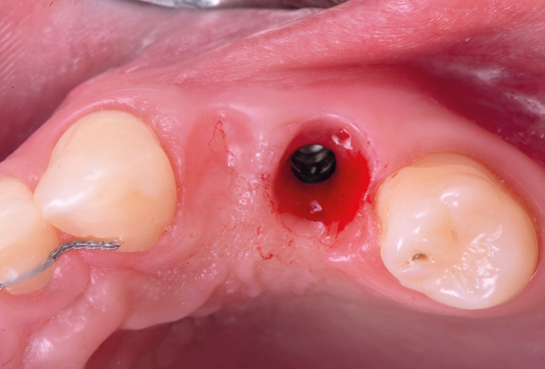 Ridge reconstruction with maxgraft® block in the posterior maxilla - Dr. A. Puišys