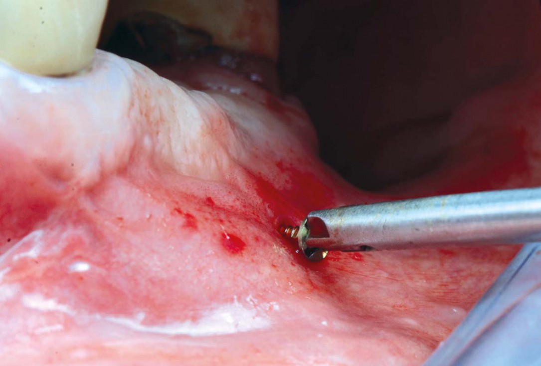 Smile rehabilitation in the anterior maxilla with maxgraft® bonebuilder - Dres. Dagba and Mourlaas  