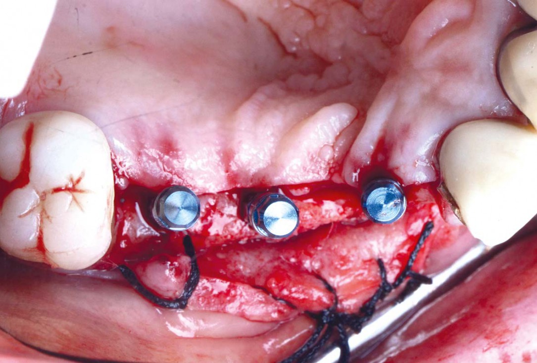 Smile rehabilitation in the anterior maxilla with maxgraft® bonebuilder - Dres. Dagba and Mourlaas  