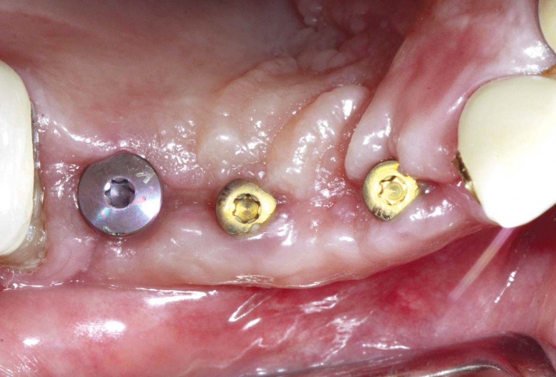 Smile rehabilitation in the anterior maxilla with maxgraft® bonebuilder - Dres. Dagba and Mourlaas  
