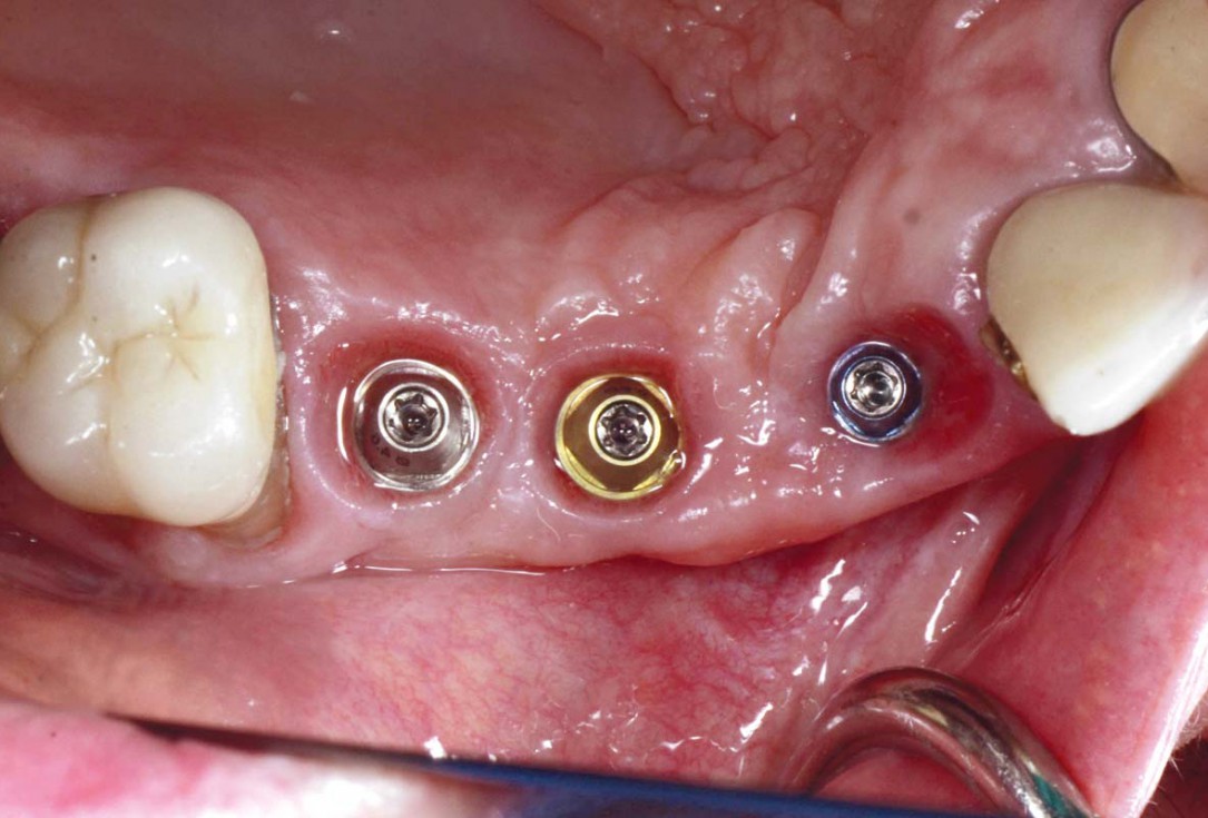 Smile rehabilitation in the anterior maxilla with maxgraft® bonebuilder - Dres. Dagba and Mourlaas  