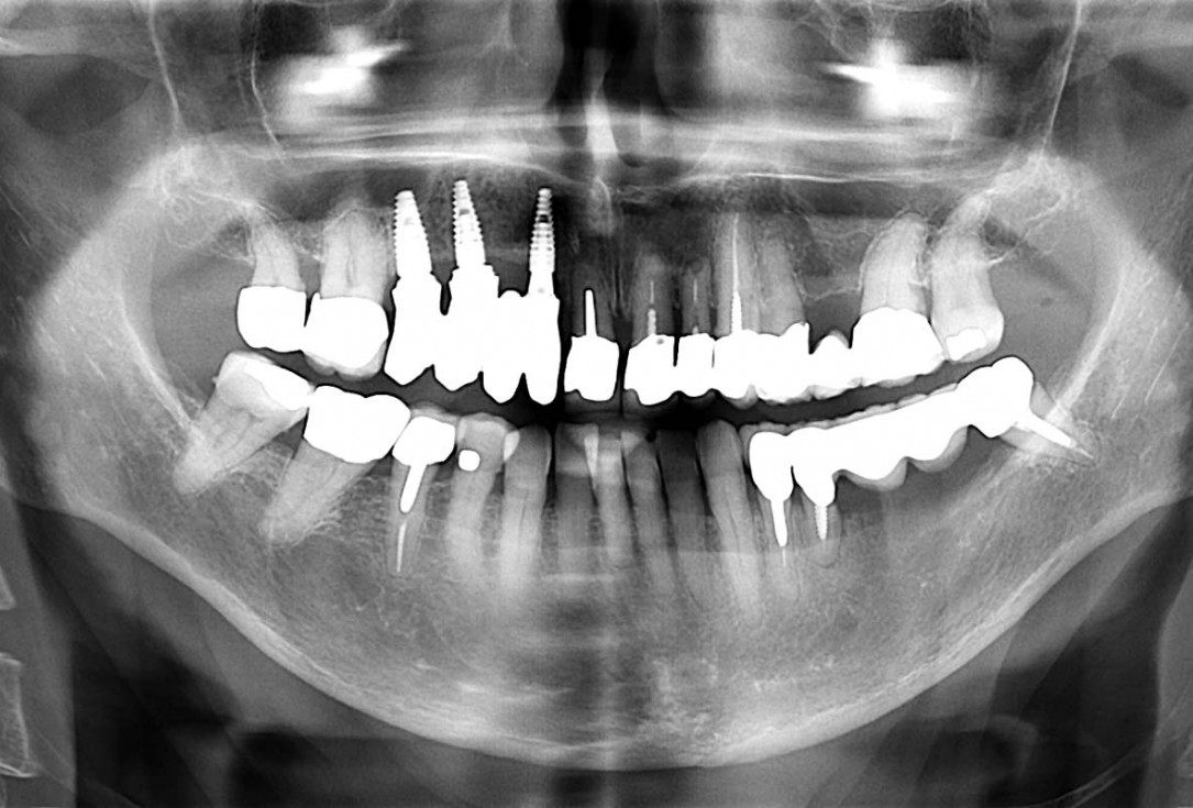 Smile rehabilitation in the anterior maxilla with maxgraft® bonebuilder - Dres. Dagba and Mourlaas  