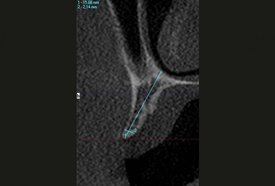 Ridge reconstruction with maxgraft® block in the posterior maxilla - Dr. A. Puišys