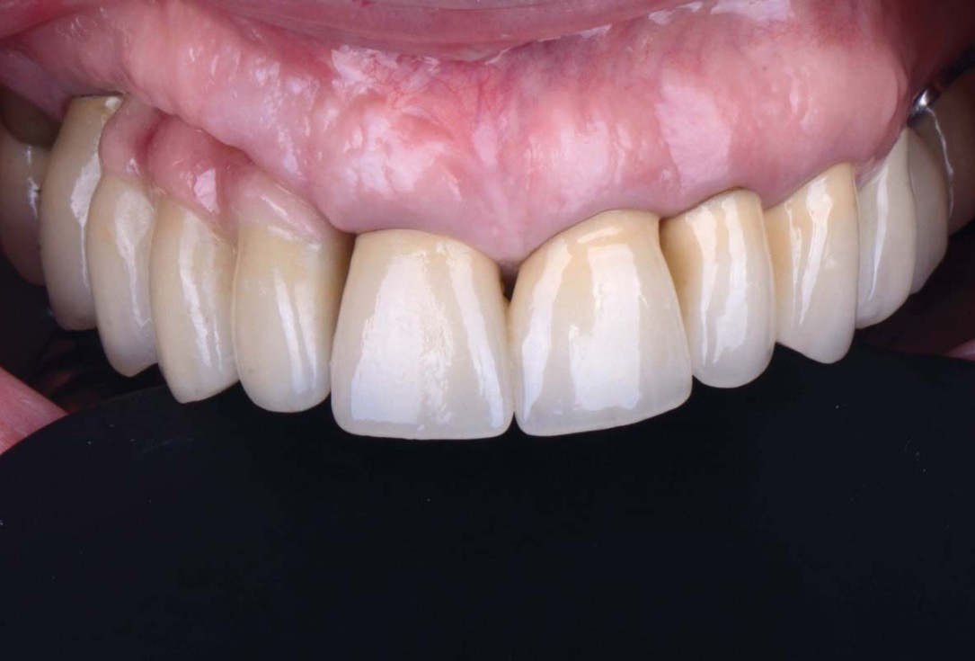 Smile rehabilitation in the anterior maxilla with maxgraft® bonebuilder - Dres. Dagba and Mourlaas  