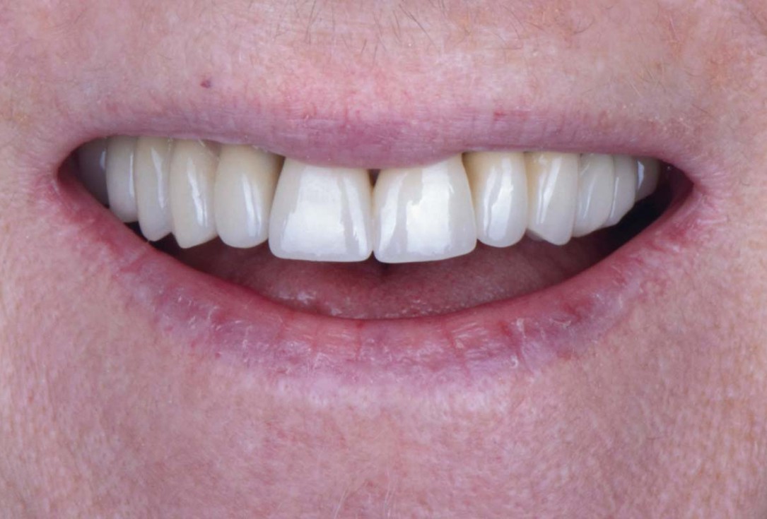 Smile rehabilitation in the anterior maxilla with maxgraft® bonebuilder - Dres. Dagba and Mourlaas  