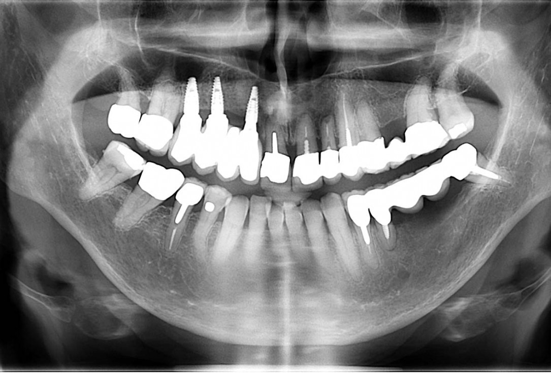 Smile rehabilitation in the anterior maxilla with maxgraft® bonebuilder - Dres. Dagba and Mourlaas  
