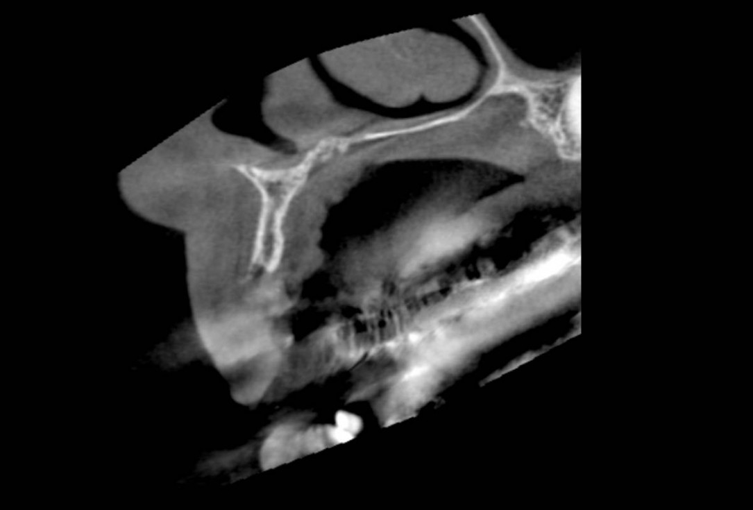 Smile rehabilitation in the anterior maxilla with maxgraft® bonebuilder - Dres. Dagba and Mourlaas  