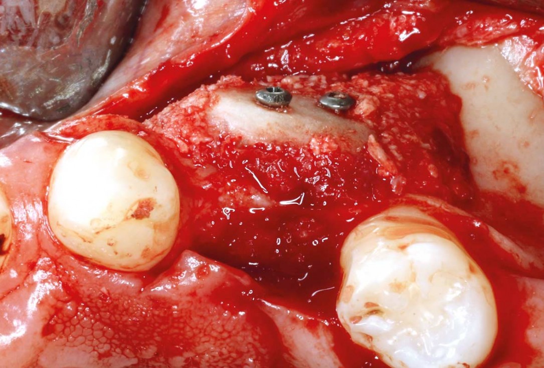 Ridge reconstruction with maxgraft® block in the posterior maxilla - Dr. A. Puišys