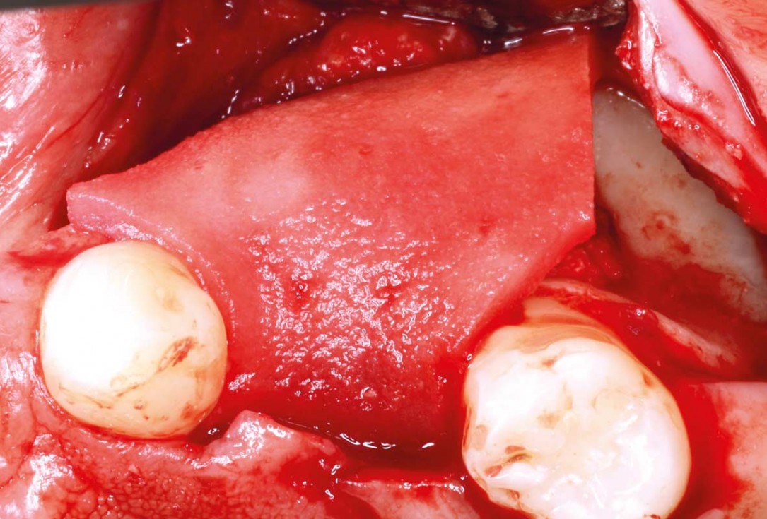 Ridge reconstruction with maxgraft® block in the posterior maxilla - Dr. A. Puišys