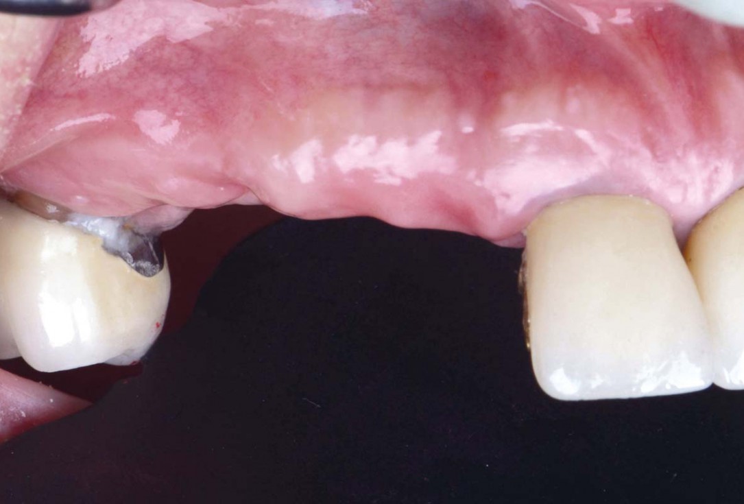 Smile rehabilitation in the anterior maxilla with maxgraft® bonebuilder - Dres. Dagba and Mourlaas  