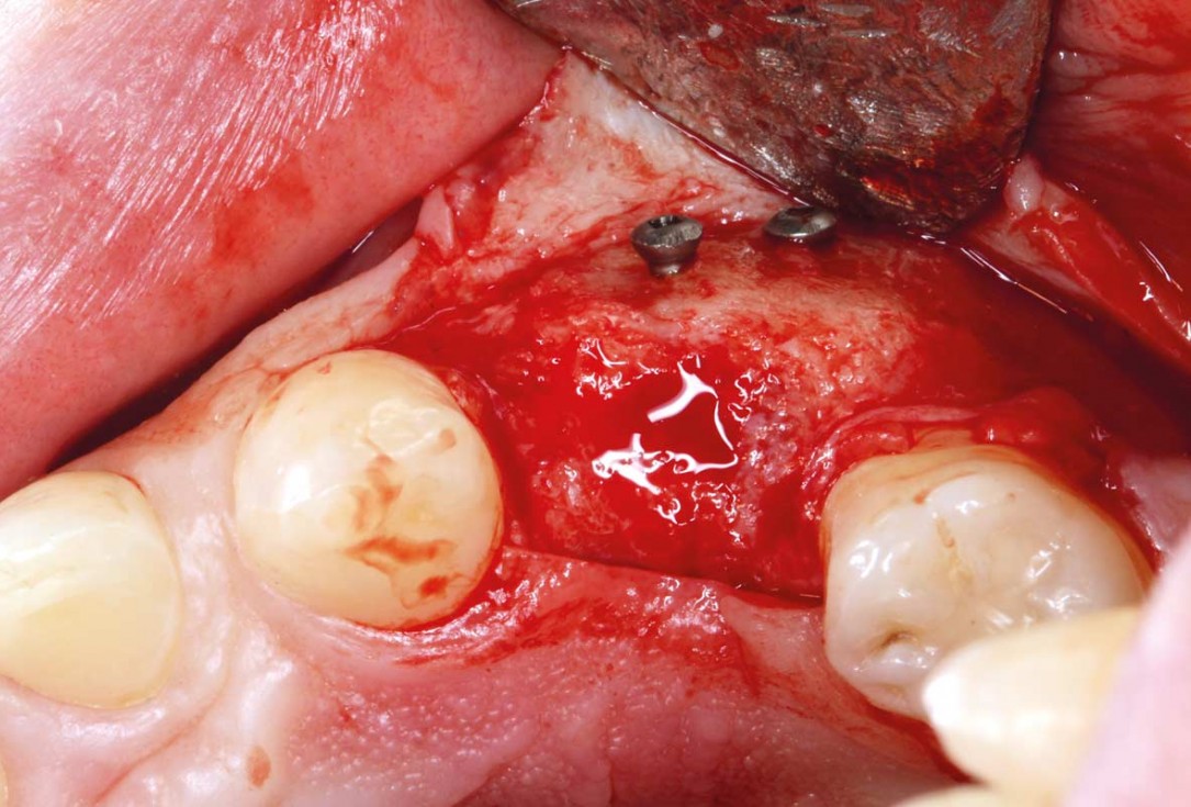 Ridge reconstruction with maxgraft® block in the posterior maxilla - Dr. A. Puišys