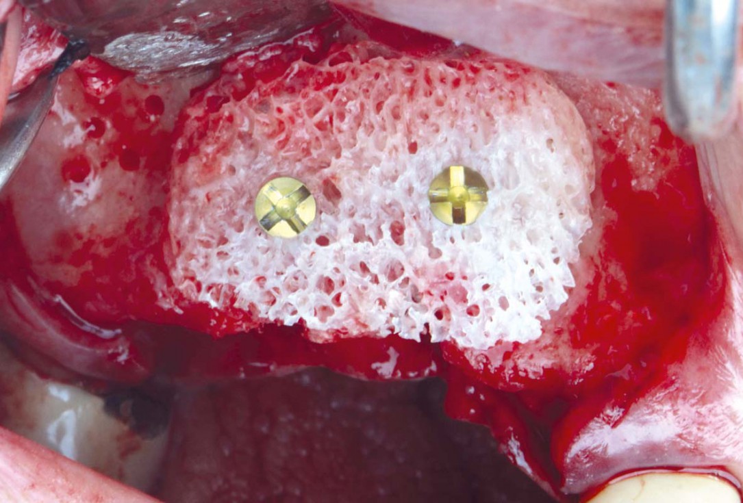 Smile rehabilitation in the anterior maxilla with maxgraft® bonebuilder - Dres. Dagba and Mourlaas  