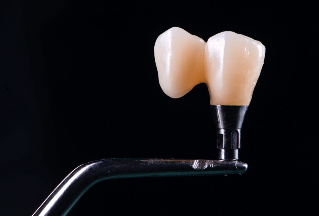 Ridge reconstruction with maxgraft® block in the posterior maxilla - Dr. A. Puišys