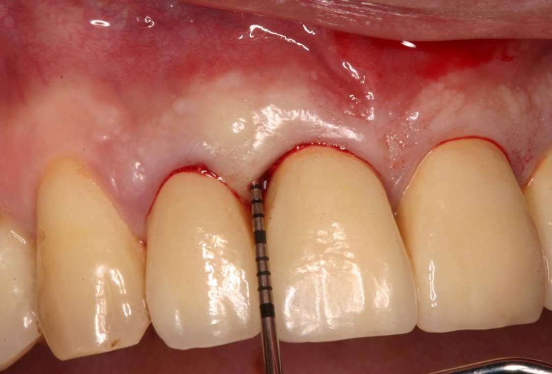 Non-contained intrabony defect treated by SPPF in conjunction with Straumann® Emdogain® and a particulate bone grafting material - Kasaj
