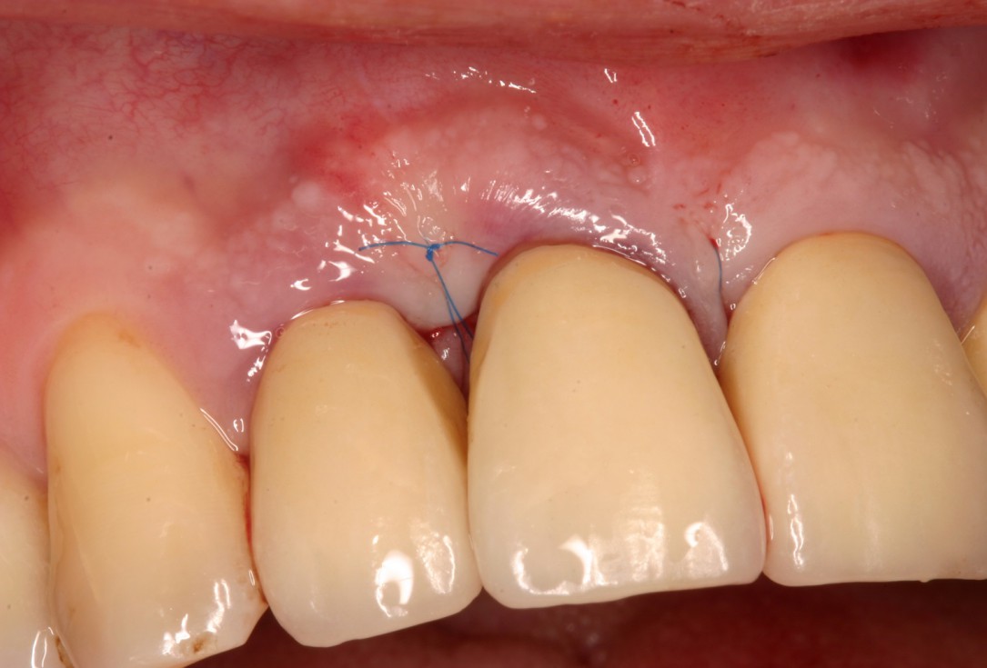 Non-contained intrabony defect treated by SPPF in conjunction with Straumann® Emdogain® and a particulate bone grafting material - Kasaj