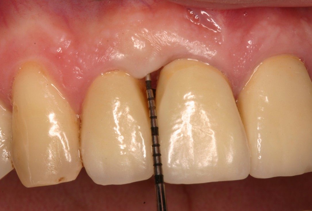Non-contained intrabony defect treated by SPPF in conjunction with Straumann® Emdogain® and a particulate bone grafting material - Kasaj