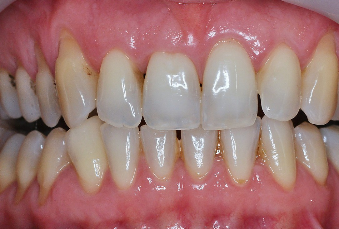 01/09 Multiple gingival recessions treated by MCAT in conjunction with mucoderm® and Straumann® Emdogain® - Hangyási