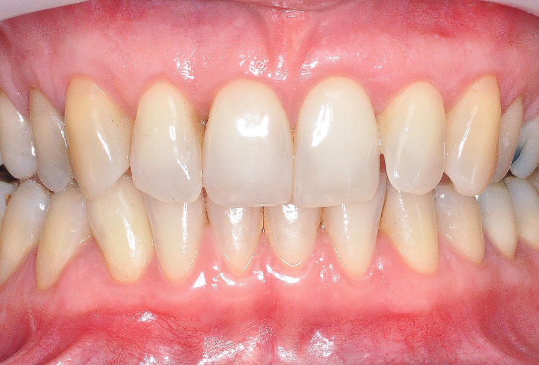 09/09 Multiple gingival recessions treated by MCAT in conjunction with mucoderm® and Straumann® Emdogain® - Hangyási