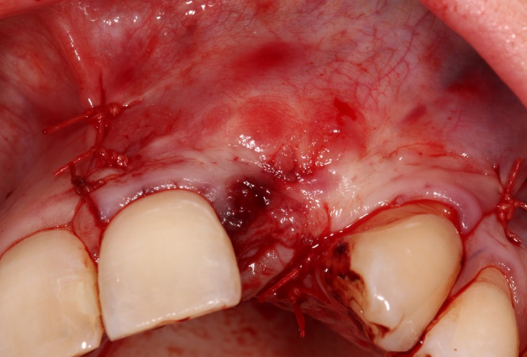 Block augmentation with maxgraft® in the maxilla - Dr. R. Cutts