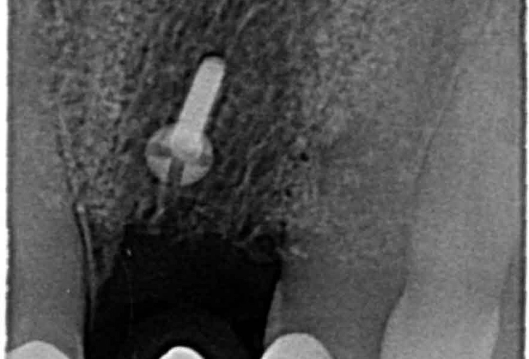 Block augmentation with maxgraft® in the maxilla - Dr. R. Cutts