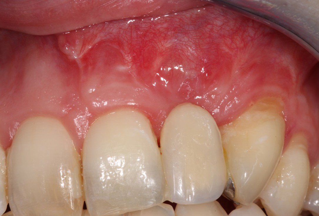 Block augmentation with maxgraft® in the maxilla - Dr. R. Cutts