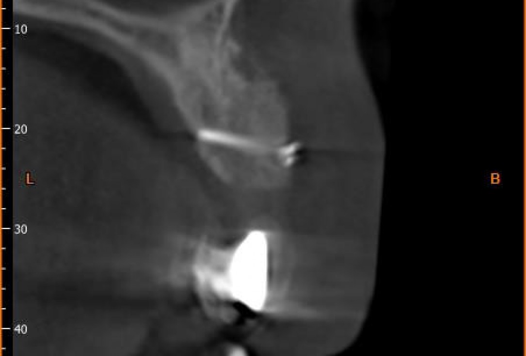 Block augmentation with maxgraft® in the maxilla - Dr. R. Cutts