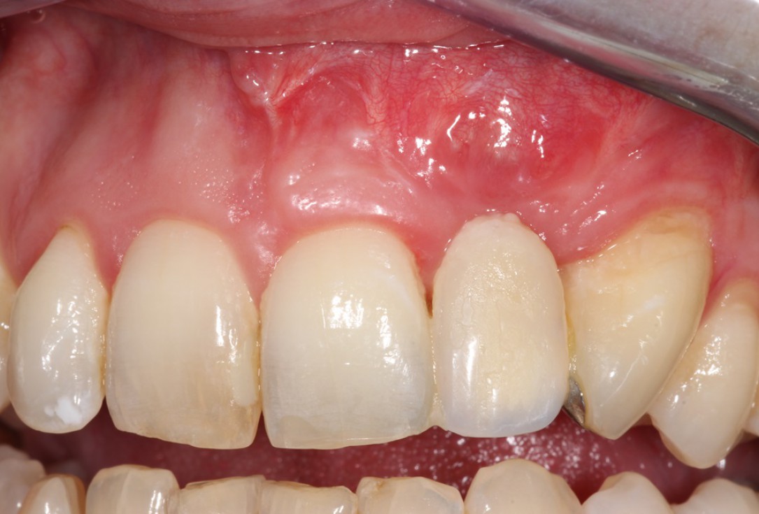 Block augmentation with maxgraft® in the maxilla - Dr. R. Cutts