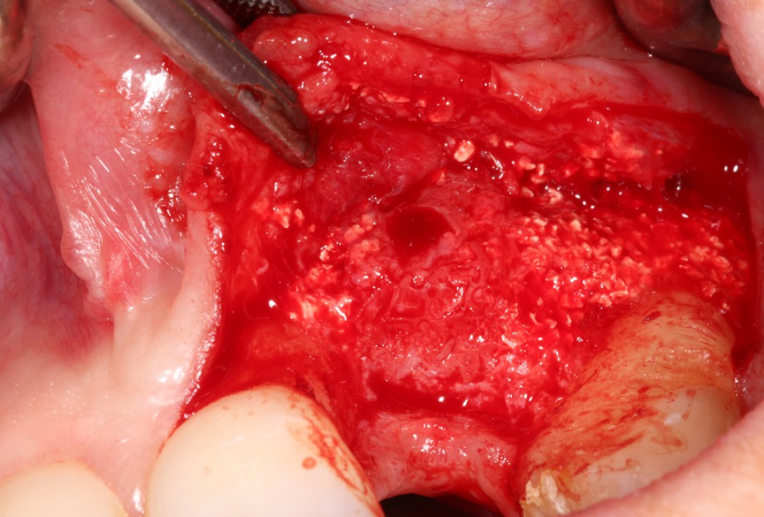 Block augmentation with maxgraft® in the maxilla - Dr. R. Cutts