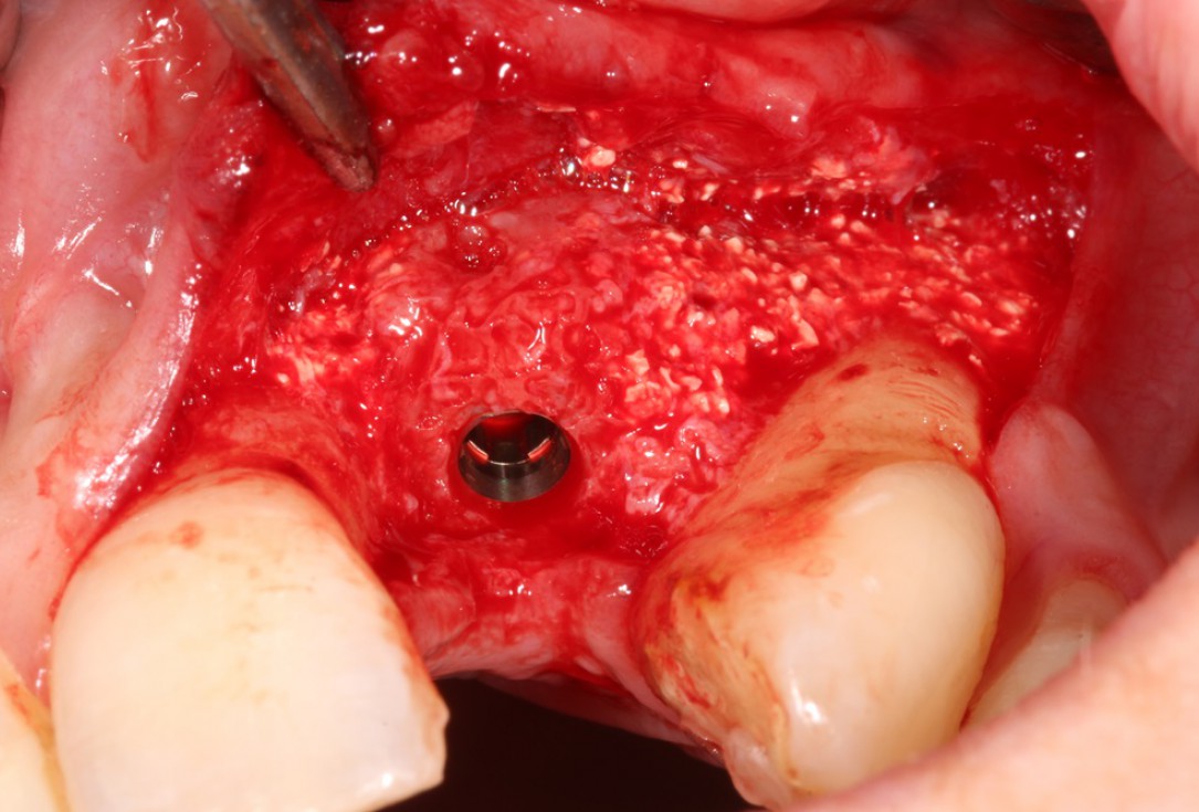 Block augmentation with maxgraft® in the maxilla - Dr. R. Cutts