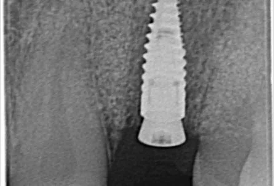 Block augmentation with maxgraft® in the maxilla - Dr. R. Cutts