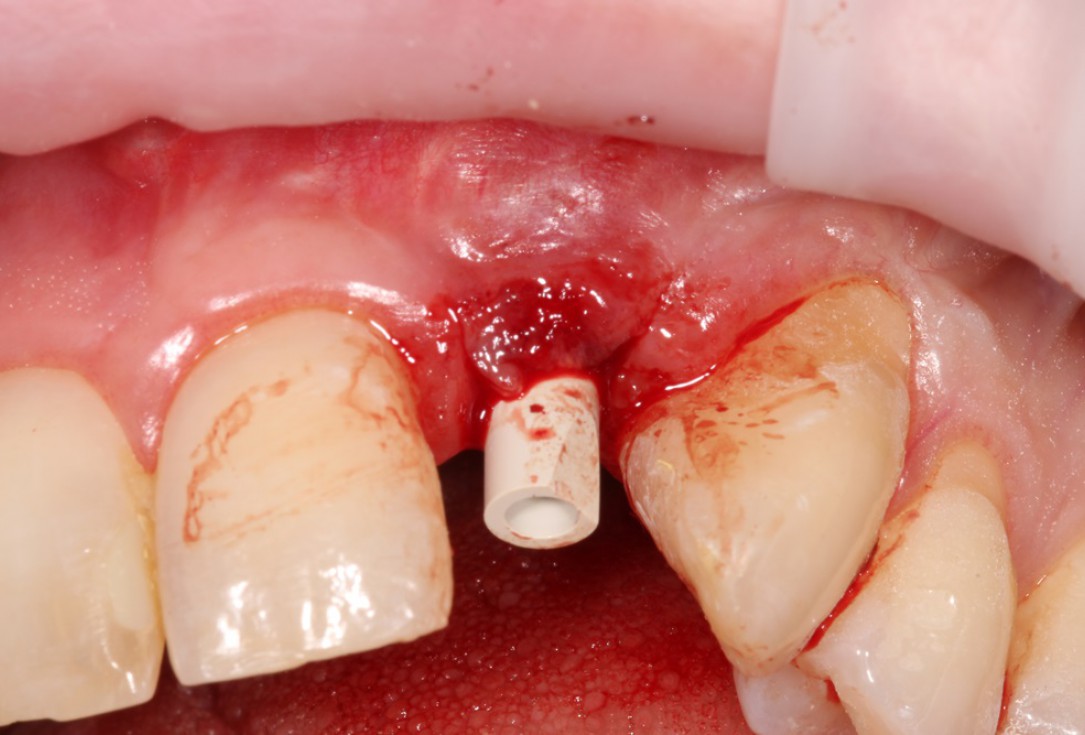 Block augmentation with maxgraft® in the maxilla - Dr. R. Cutts